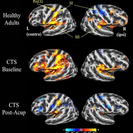 The effects of acupuncture on the brain.