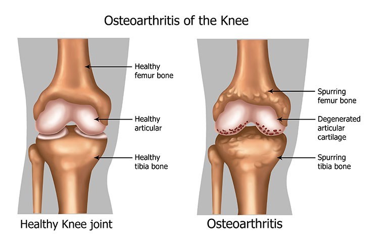 Osteoarthritis Pain Relief In Bellmore , NY - Bellmore Acupuncture Clinic